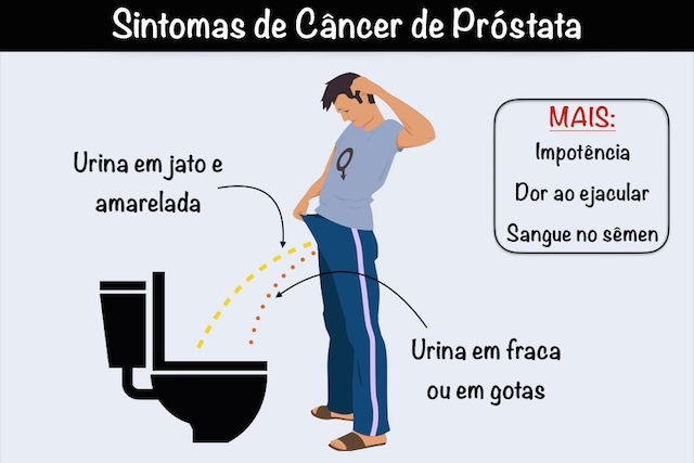 Resultado de imagem para cancer de prostata